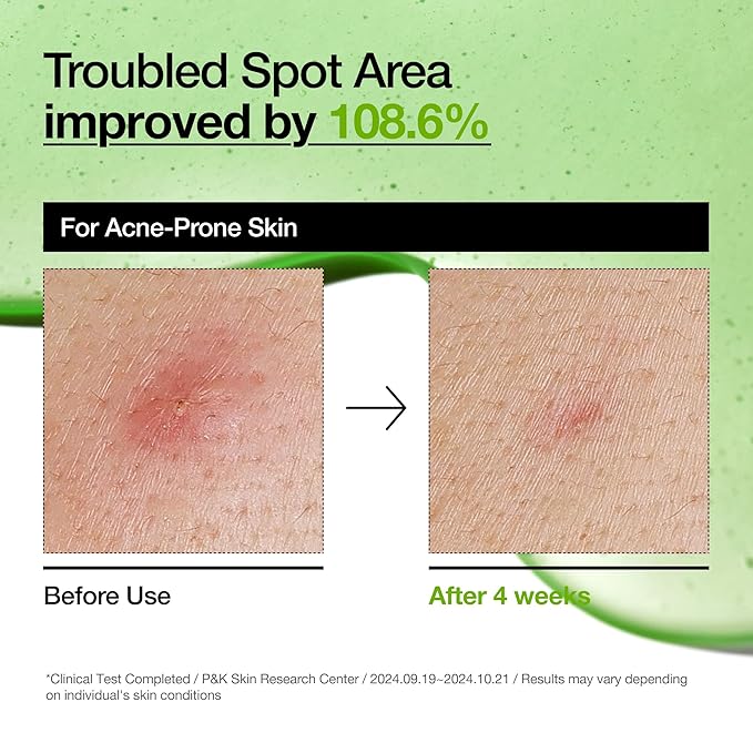 ANUA Azelaic Acid 10 Hyaluron Redness Soothing Serum 30ml/ 1.01 fl oz.